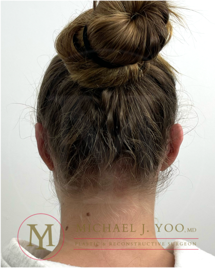 Otoplasty Before & After Patient #4533