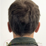 Otoplasty Before & After Patient #4530