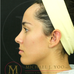 Forehead Reduction Before & After Patient #4534