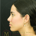 Forehead Reduction Before & After Patient #4534