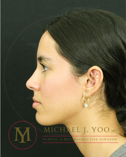 Forehead Reduction Before & After Patient #4534