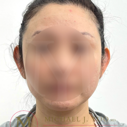 Otoplasty Before & After Patient #4575