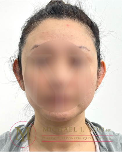 Otoplasty Before & After Patient #4575