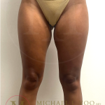 Thigh Liposuction Before & After Patient #4576