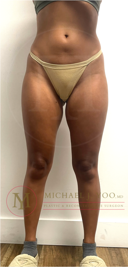 Thigh Liposuction Before & After Patient #4576