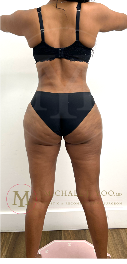 Tummy Tuck Before & After Patient #4577