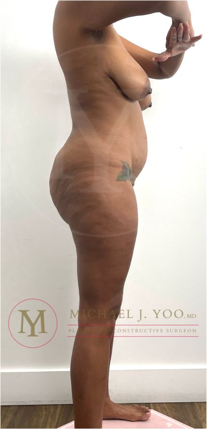 Tummy Tuck Before & After Patient #4577
