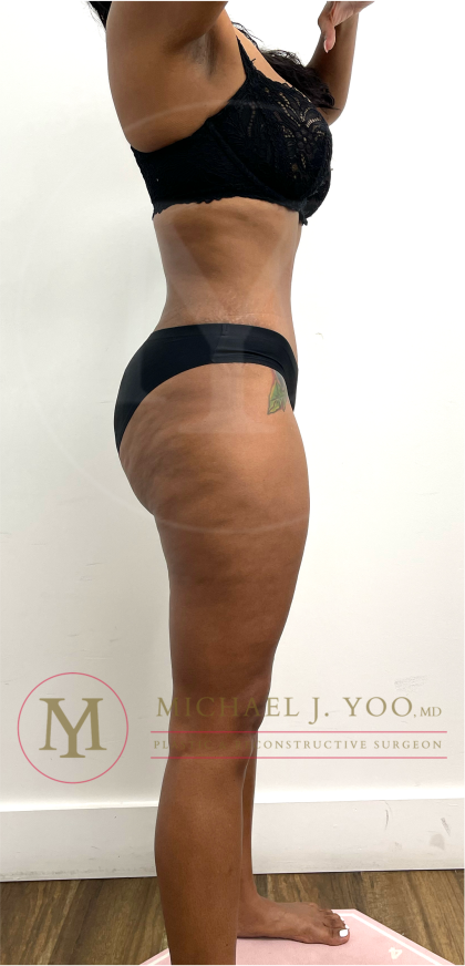 Tummy Tuck Before & After Patient #4577