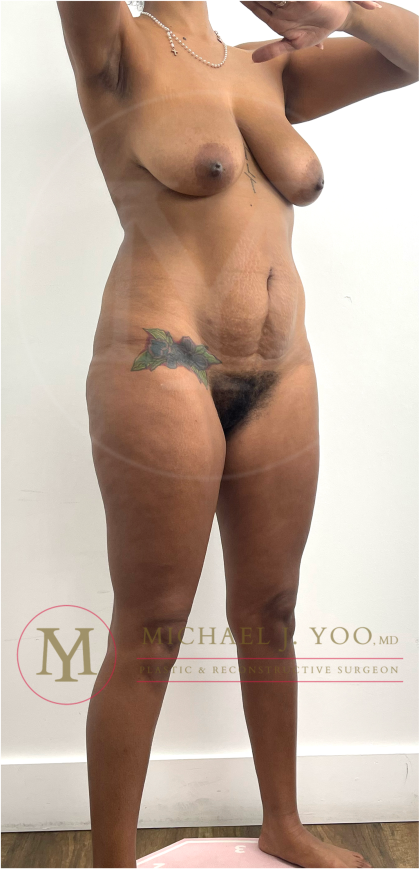 Tummy Tuck Before & After Patient #4577