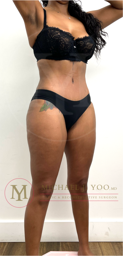 Tummy Tuck Before & After Patient #4577