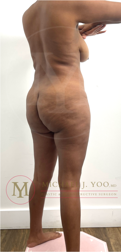 Tummy Tuck Before & After Patient #4577