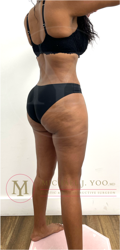 Tummy Tuck Before & After Patient #4577
