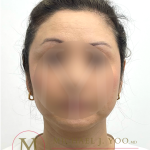 Otoplasty Before & After Patient #4575