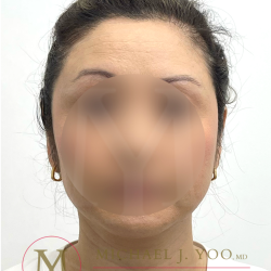 Otoplasty Before & After Patient #4575