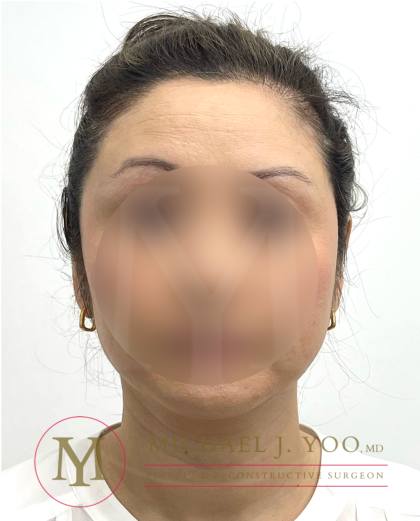Otoplasty Before & After Patient #4575