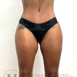 Tummy Tuck Before & After Patient #4577