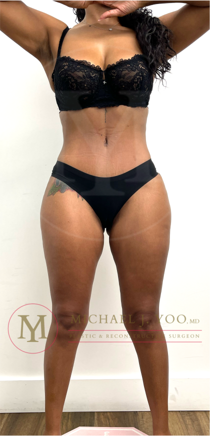 Tummy Tuck Before & After Patient #4577