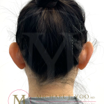 Otoplasty Before & After Patient #4575