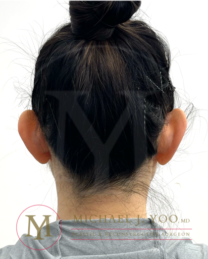 Otoplasty Before & After Patient #4575
