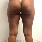 Thigh Liposuction Before & After Patient #4576