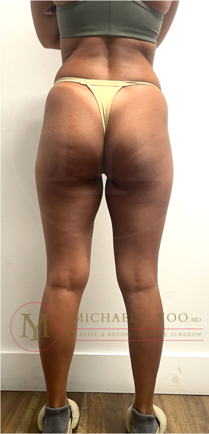 Thigh Liposuction Before & After Patient #4576