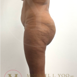 Tummy Tuck Before & After Patient #4577