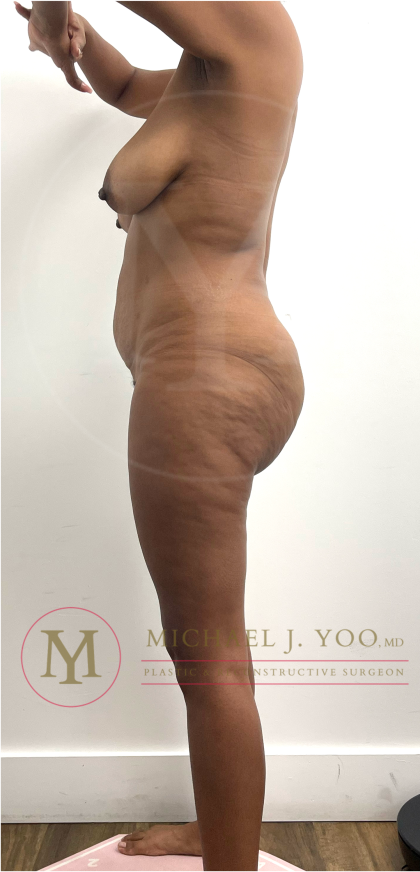 Tummy Tuck Before & After Patient #4577