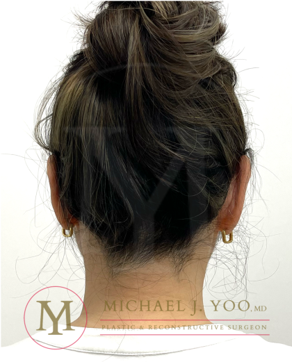 Otoplasty Before & After Patient #4575