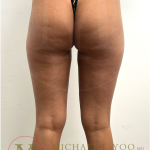 Thigh Liposuction Before & After Patient #4576