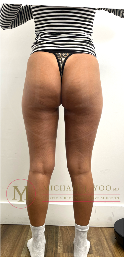 Thigh Liposuction Before & After Patient #4576