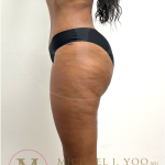 Tummy Tuck Before & After Patient #4577