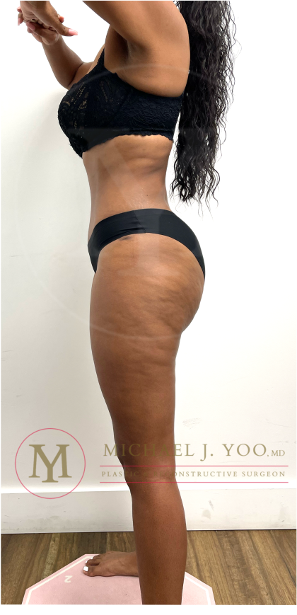 Tummy Tuck Before & After Patient #4577