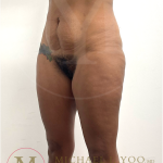 Tummy Tuck Before & After Patient #4577