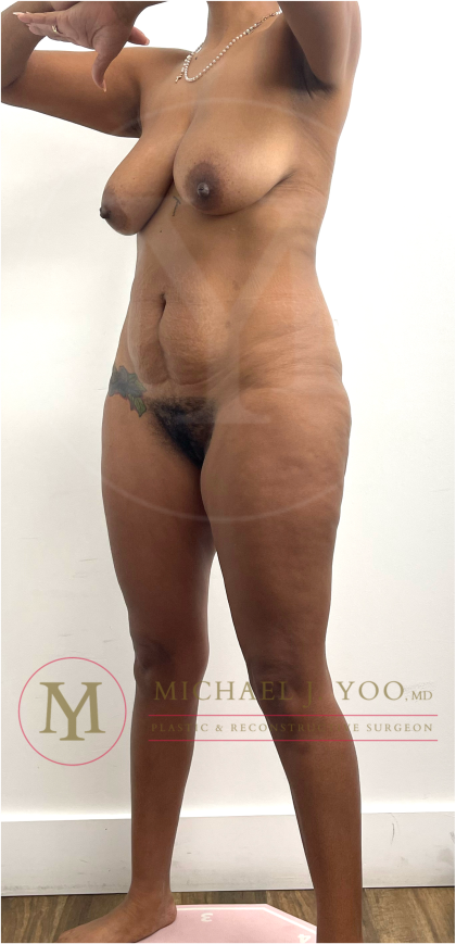 Tummy Tuck Before & After Patient #4577