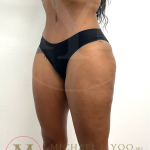 Tummy Tuck Before & After Patient #4577