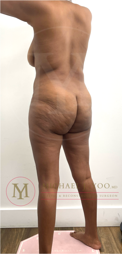 Tummy Tuck Before & After Patient #4577