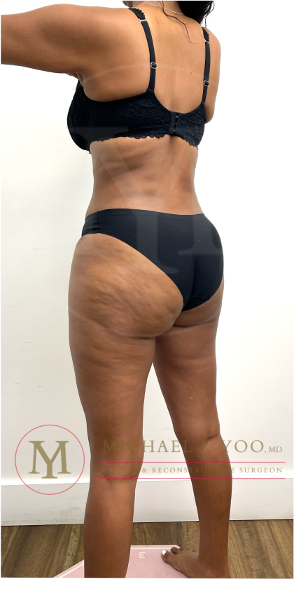 Tummy Tuck Before & After Patient #4577