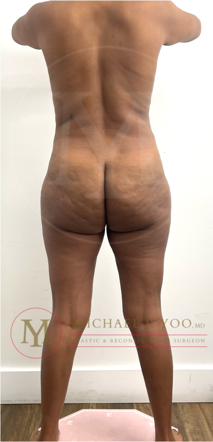 Tummy Tuck Before & After Patient #4577